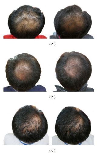 Can pumpkin seed oil help with hair loss